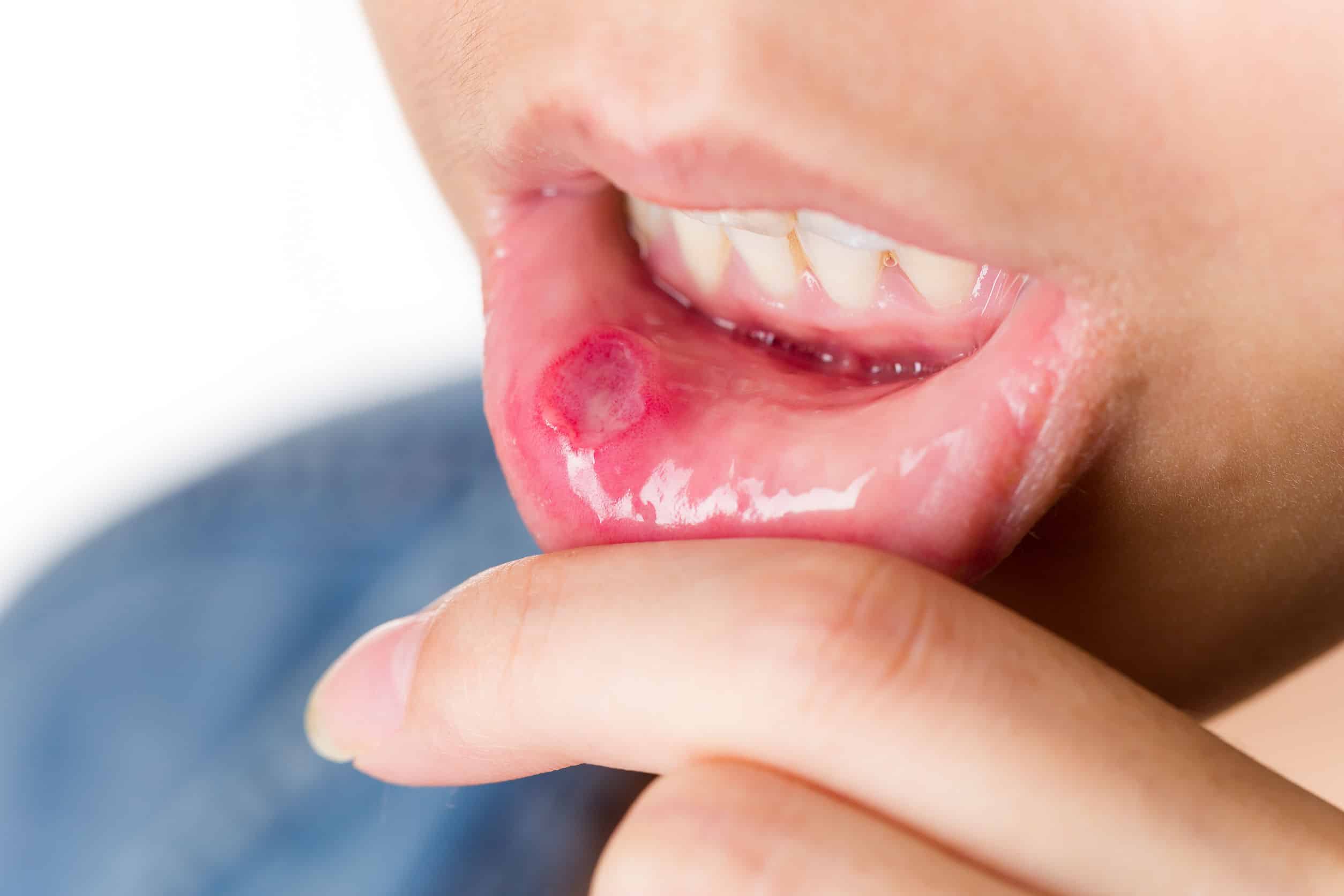 Afta: por que temos essas dolorosas feridas na boca? Entenda as causas mais comuns e como curá-las